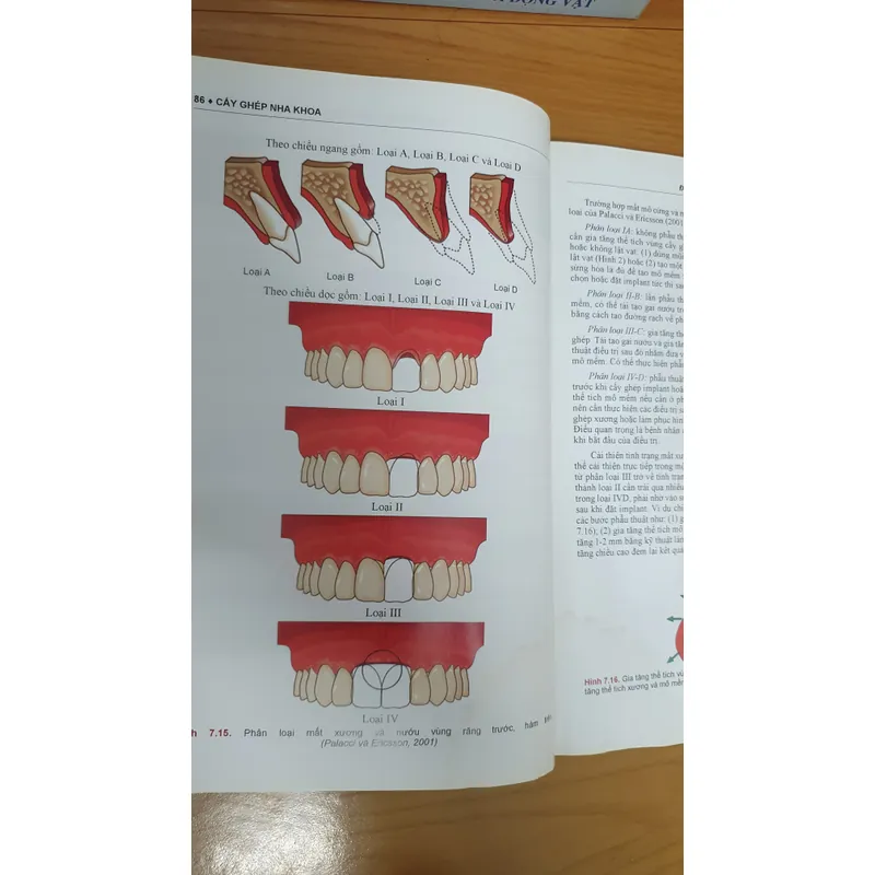 CẤY GHÉP NHA KHOA 740877