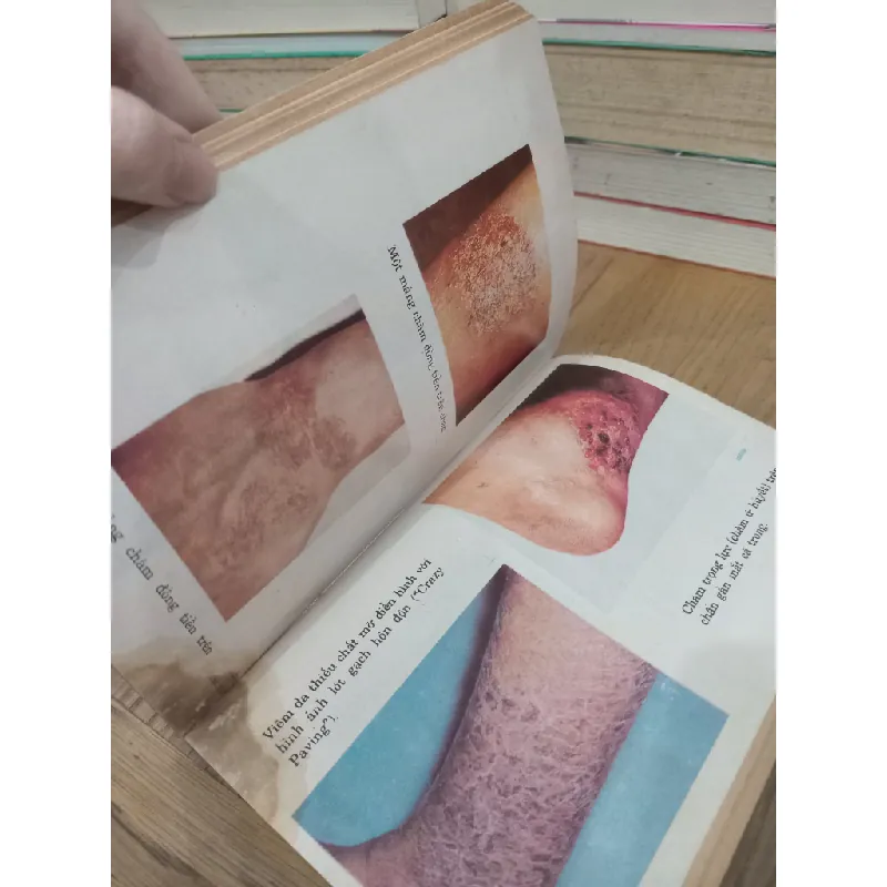 Bệnh chàm - S.J.Kawalkar, M.D, D.V.D, G.Blum, M.D 721100