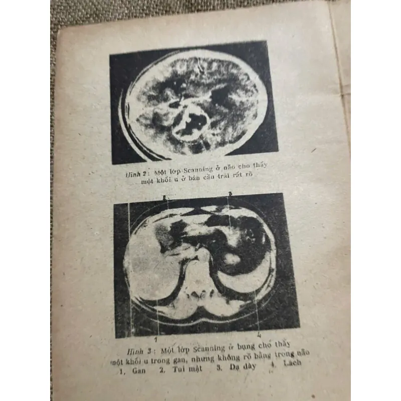 BỆNH LÝ NGOẠI KHOA THẦN KINH - SÁCH Y 571834