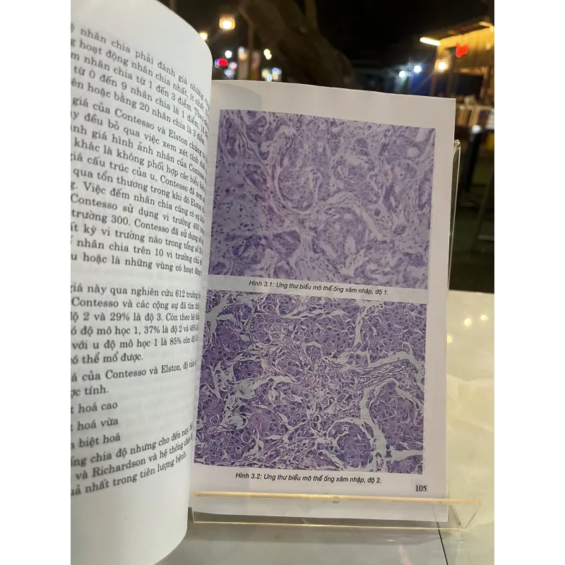 BỆNH UNG THƯ VÚ - NGUYỄN BÁ ĐỨC 757170