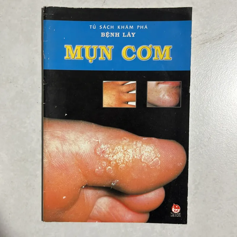Mụn cơm - bệnh lây 589695