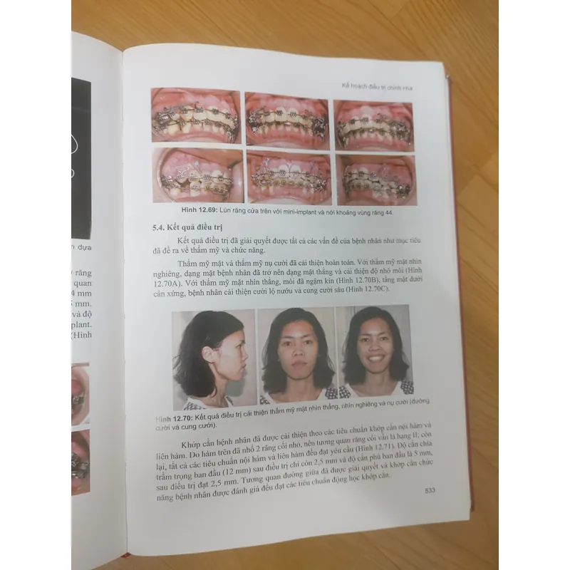 CHỈNH NHA LÂM SÀNG TẬP 1 689476