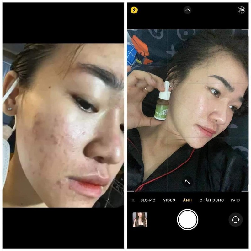 Serum diếp cá IGREEN dành cho da mụn 99491