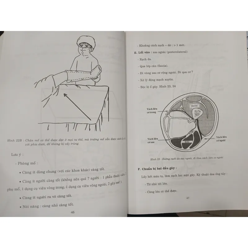 GÃY THÂN XƯƠNG ĐÙI - TỔN THƯƠNG, CHẨN ĐOÁN, ĐIỀU TRỊ 595415