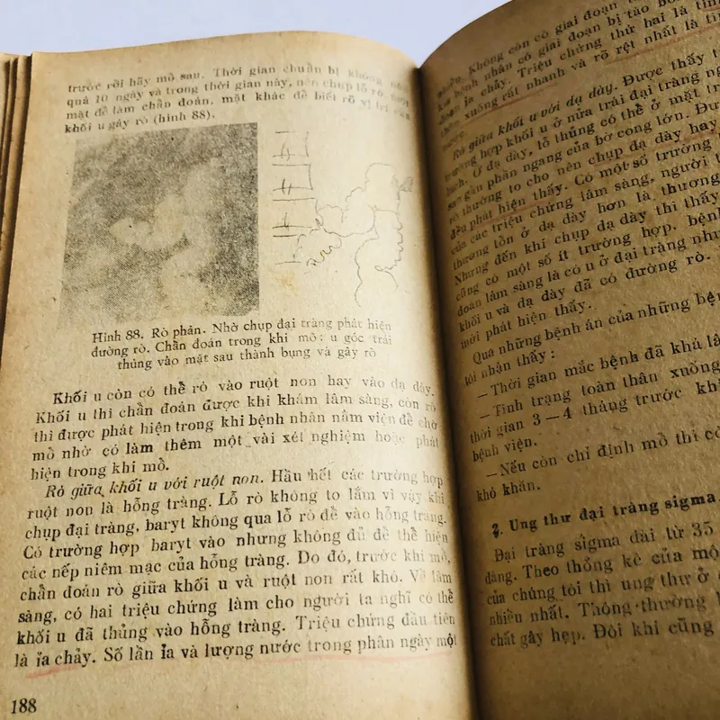 UNG THƯ ĐẠI TRÀNG 707184