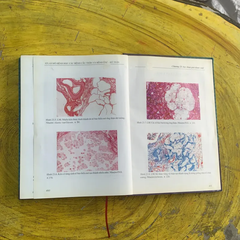 ATLAS MÔ BỆNH HỌC CÁC BỆNH CẦU THẬN & BỆNH ỐNG - KẼ THẬN 1009009