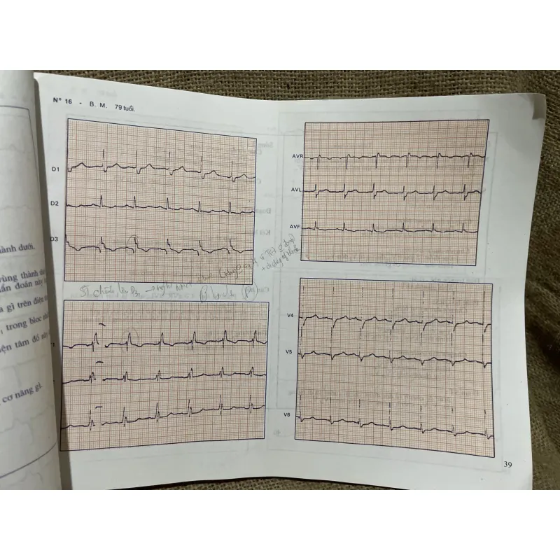 Bài tập điện tâm đồ- M. ENGLERT - R. BERNARD - Dùng cho sinh viên y khoa và bác sỹ 933850