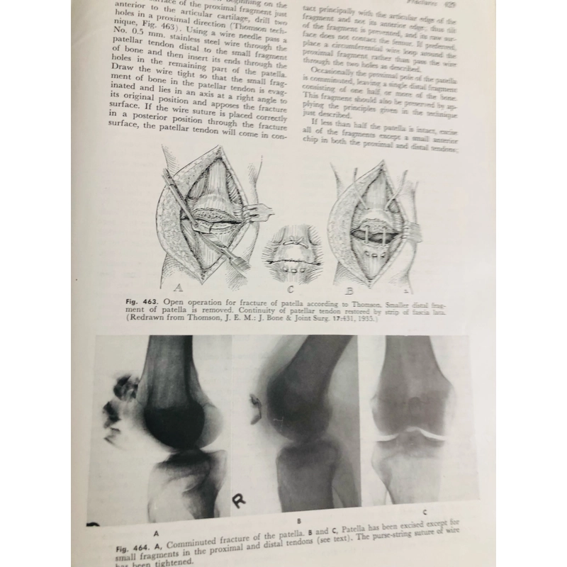 CAMPBELL’S OPERATIVE ORTHOPAEDICS ( chỉnh hình phẫu thuật) 470880