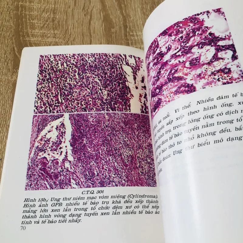 U ÁC TÍNH VÙNG MIỆNG - HÀM MẶT  933205