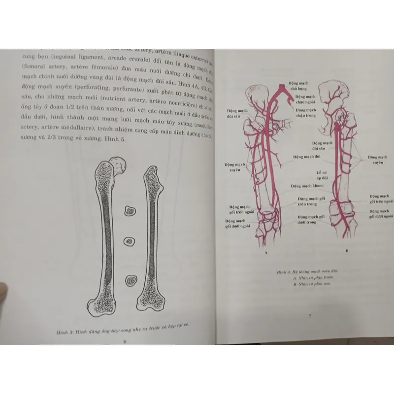 GÃY THÂN XƯƠNG ĐÙI - TỔN THƯƠNG, CHẨN ĐOÁN, ĐIỀU TRỊ 595415