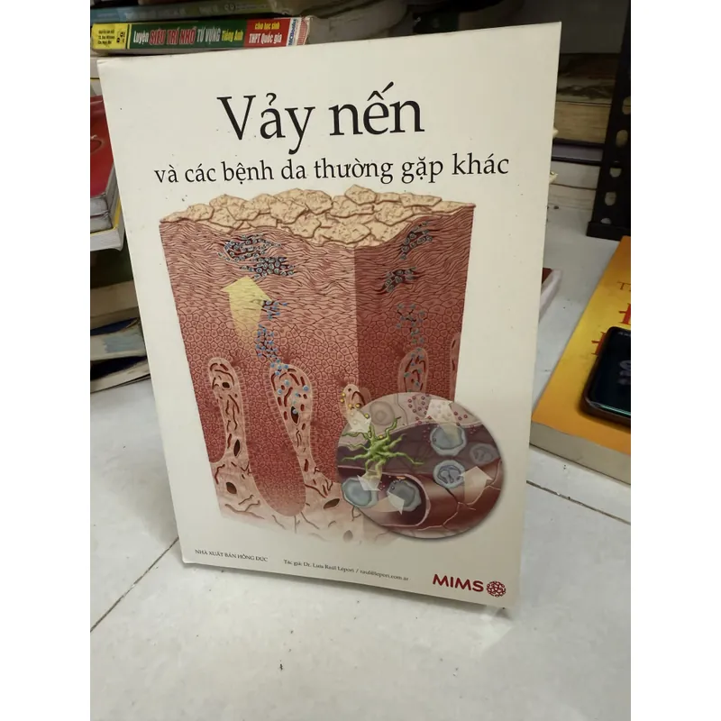 Vảy nến.     594409