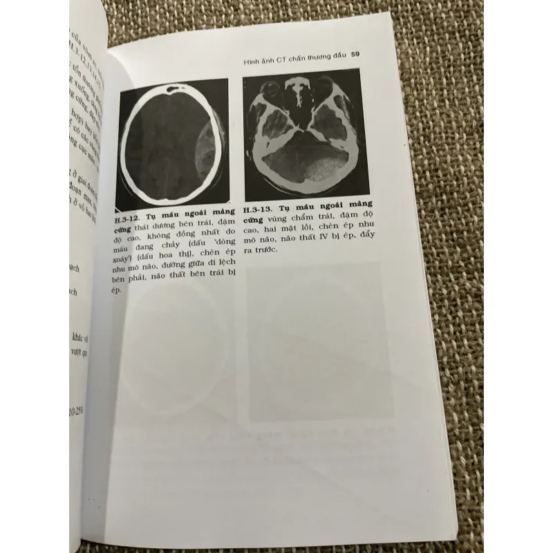 CT chấn thương đầu - PGS. PHẠM NGỌC HOA ThS. LÊ VẤN PHƯỚC; 150 trang khổ lớn  1021342