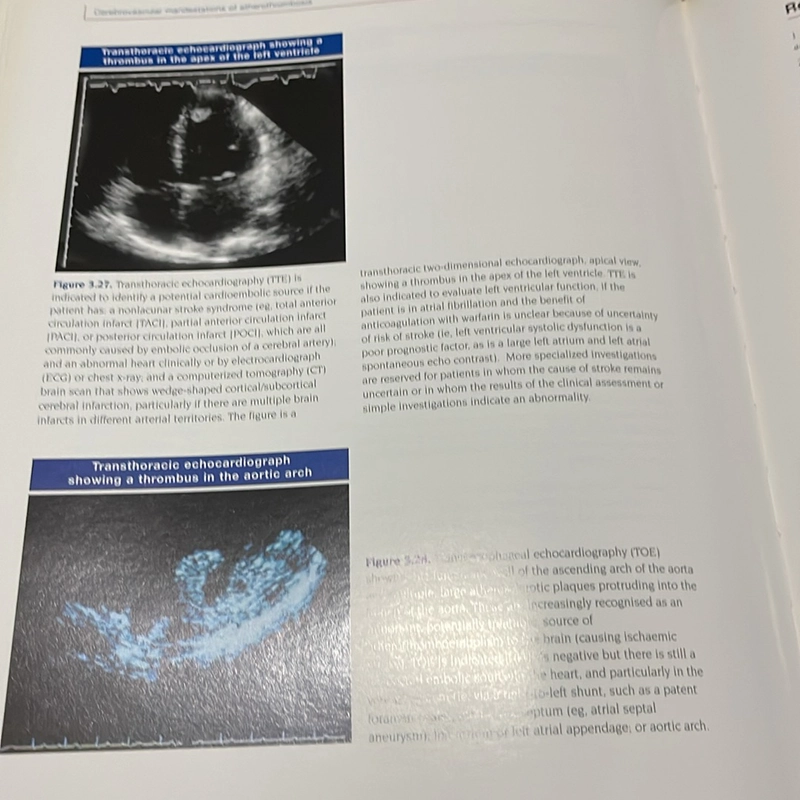 PICTURE BOOK Atlas of atherothrombosis 536358