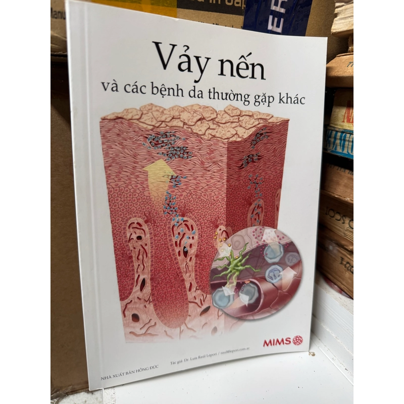 Vảy nến      541103