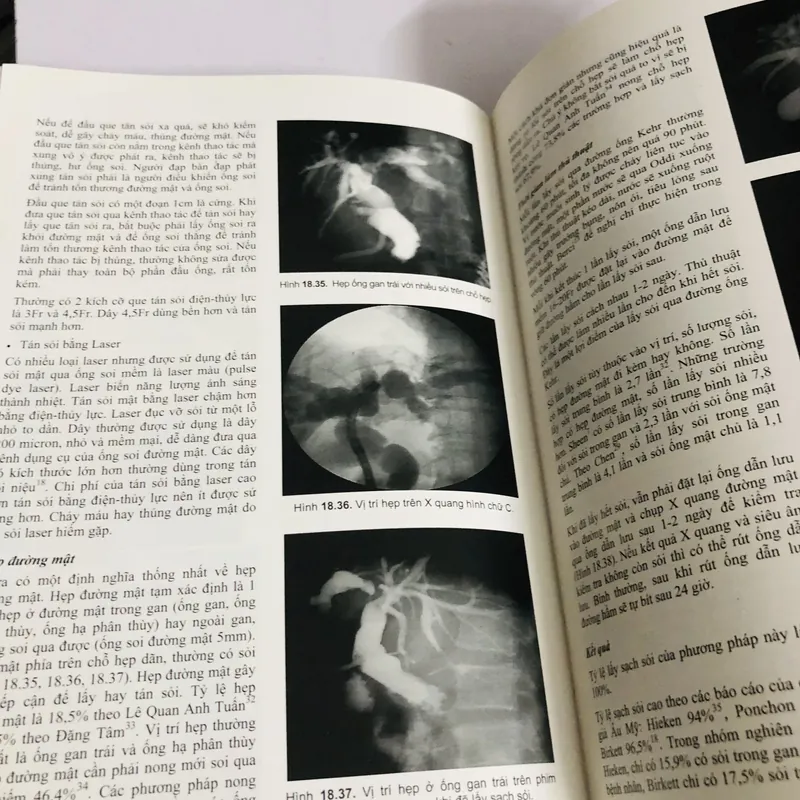 📘 SỎI ĐƯỜNG MẬT – Nguyễn Đình Hối & Nguyễn Mậu Anh 700887