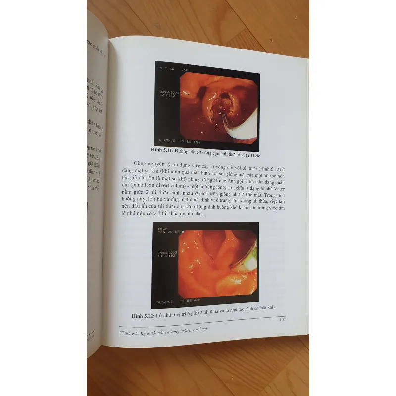 NỘI SOI MẶT TUY  754032